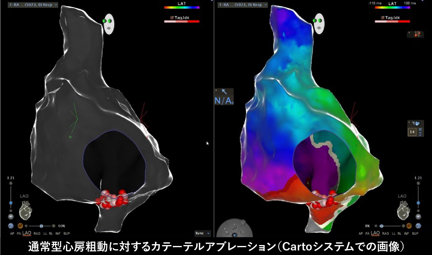 カテーテルアブレーション