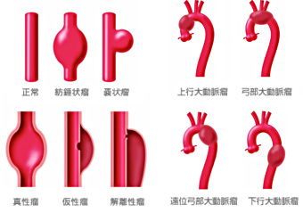大動脈瘤の形態・原因・部位による分類