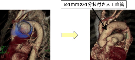 胸部大動脈人工血管置換術