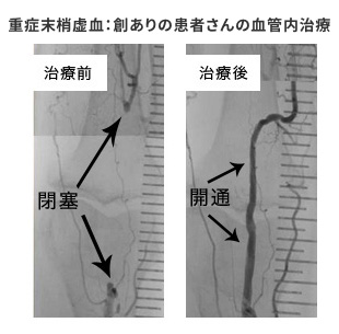 血管内治療