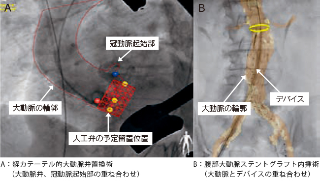 術中透視画像とCT画像の重ね合わせ