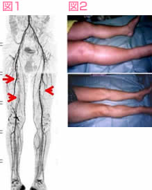 大腿動脈の治療