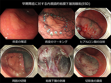 内視鏡的粘膜下層剥離術