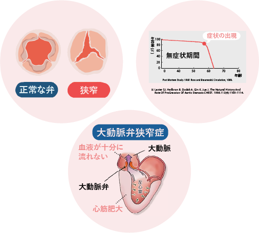 大動脈弁狭窄症について