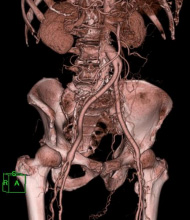 大動脈-両側大腿動脈バイパス