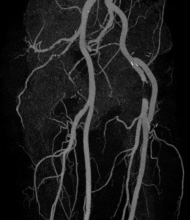 外腸骨動脈-大腿動脈バイパス