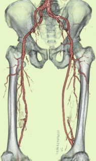 外腸骨動脈-大腿動脈バイパス